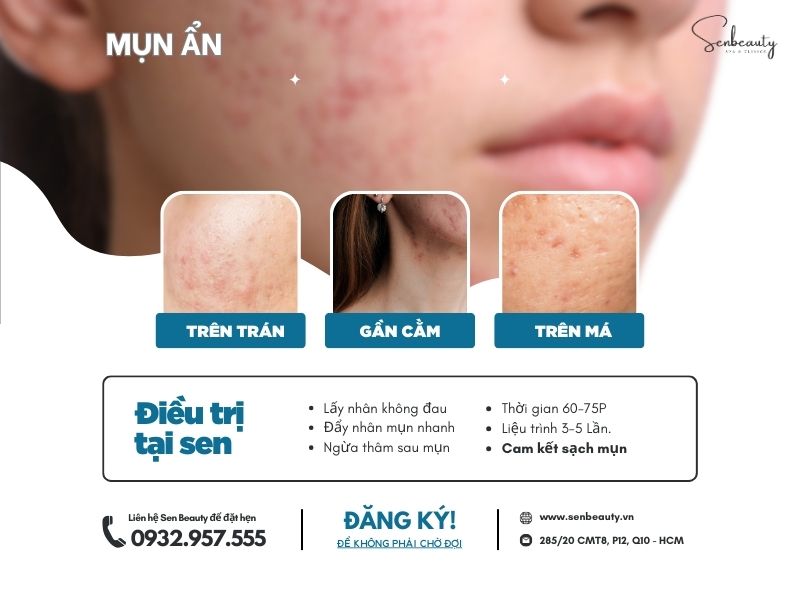Trị các loại mụn nhọt trứng cá có cam kết